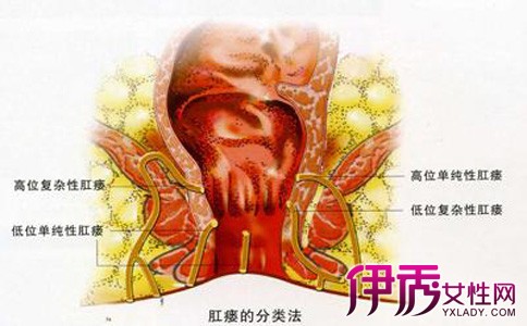 做肛瘘手术多长时间能同房_肛瘘手术多久能同房男_做肛瘘多久可以同房