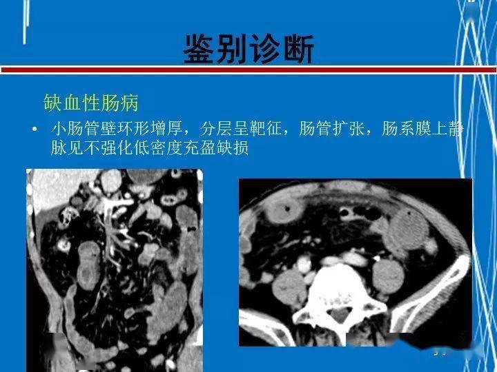 克罗恩病诊断标准_克罗恩病诊断书写_诊断克罗恩的标准